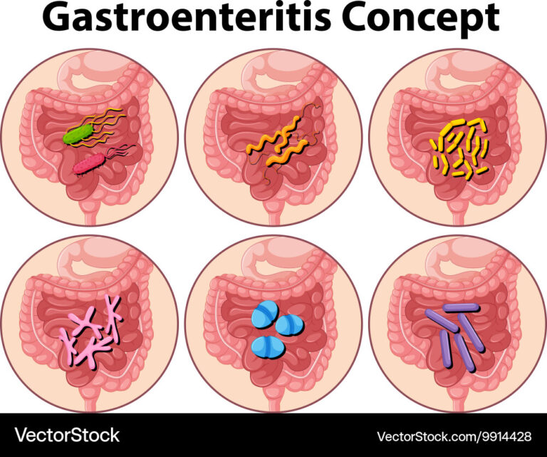 Gastroenteritis Gastroenteritis
